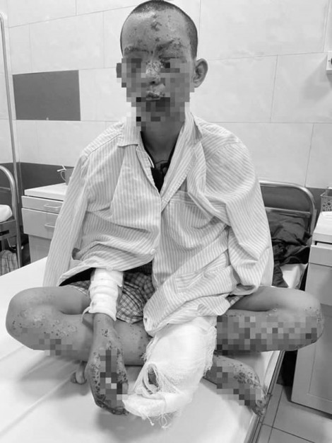 Người đàn ông bị cháy xạm toàn thân khi dùng điện thoại khi đang sạc