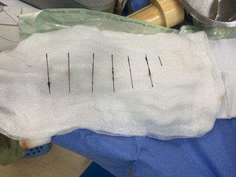 Mổ lấy 7 cây kim gỉ sét trong lồng ngực bệnh nhân