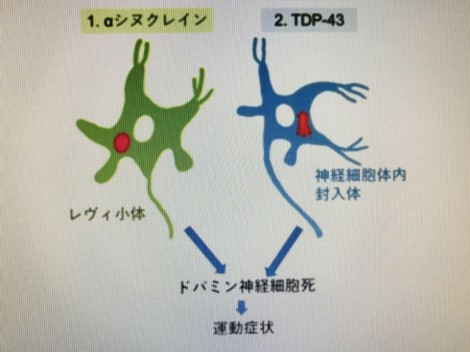 Nhật Bản phát hiện một loại prôtêin mới gây bệnh Parkinson
