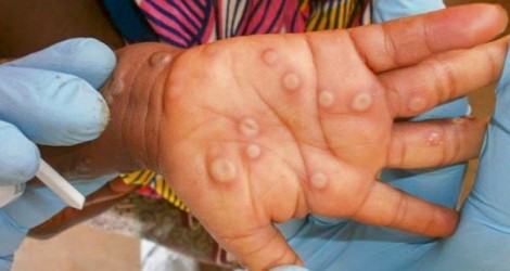 95% số ca đậu mùa khỉ lây bệnh qua sinh hoạt tình dục