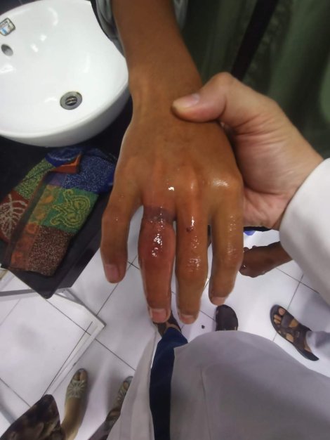 Mua nhẫn trên mạng về đeo, hai đứa trẻ suýt hoại tử ngón tay