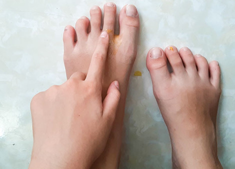 Ðiều trị tại nhà bàn chân nhiễm nấm