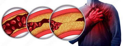 Duy trì mức cholesterol lành mạnh giúp bảo vệ tim và trí não