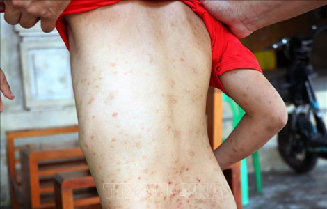 Xử lý ổ côn trùng bọ chét ký sinh trên vật nuôi lây sang người