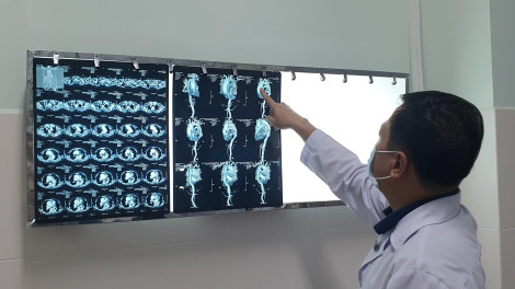Cứu sống cụ bà vỡ túi phình động mạch chủ ngực