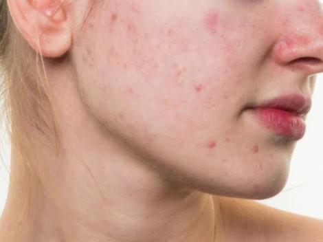 Bí kíp xử lý mụn viêm khi mùa hè đến
