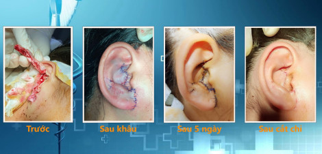 Tạo hình thành công vành tai gần đứt lìa của bé gái