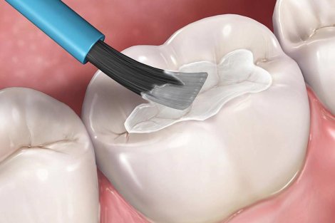 Trám răng liệu có bền chắc? Bao lâu thì cần trám lại?