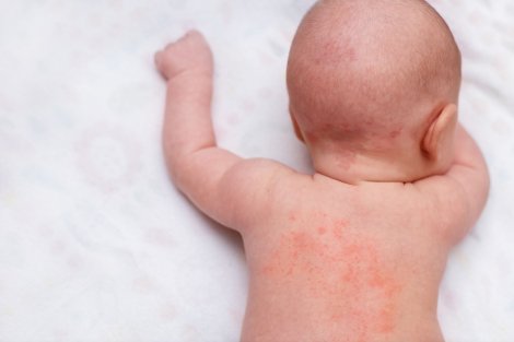 Những lưu ý khi muốn dùng lá tắm dân gian trị rôm sảy cho bé