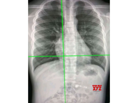 AI có thể dự đoán tuổi thọ qua hình ảnh X-quang ngực