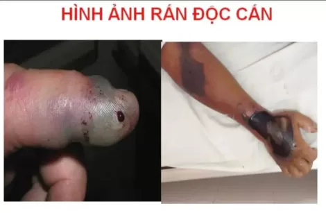 Báo động rắn cắn trẻ nhỏ