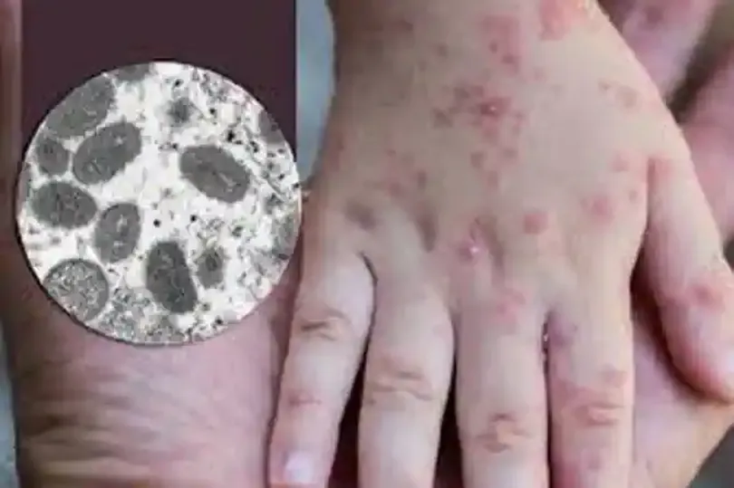 Cần Thơ ghi nhận ca đậu mùa khỉ đầu tiên