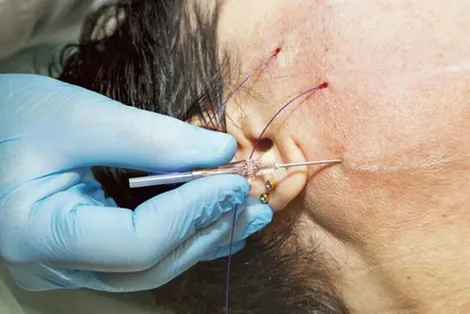Căng da mặt ở đâu đẹp, chất lượng và đảm bảo an toàn hiện nay?
