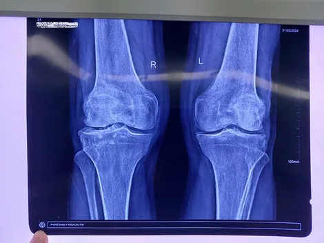Nội soi lấy sỏi trong đầu gối bệnh nhân 71 tuổi