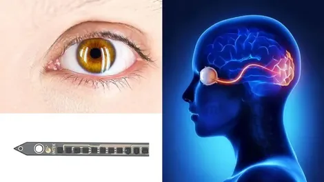 Triển vọng điều trị mù lòa nhờ thiết bị cấy ghép mắt siêu nhỏ