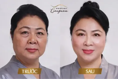 Những lưu ý khi thực hiện căng da mặt? Điểm tên công nghệ mới nhất?