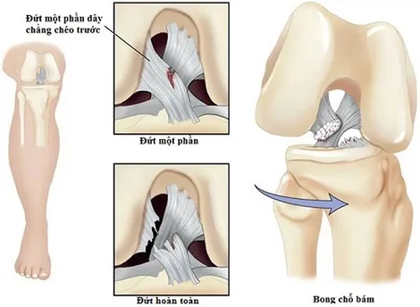 Đứt bán phần dây chằng chéo trước có tự lành không? Bác sĩ hướng dẫn cách hồi phục