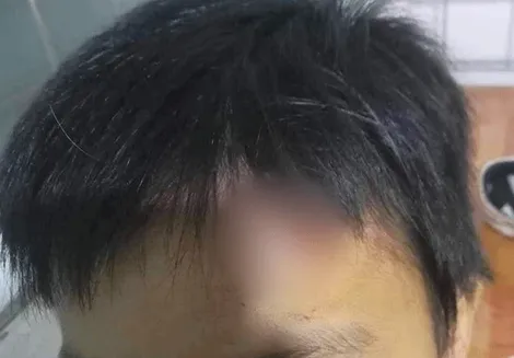 Cà Mau: Chỉ đạo làm rõ vụ “cháu bé từng bị hành hạ lại bị bầm mình, rách đầu”