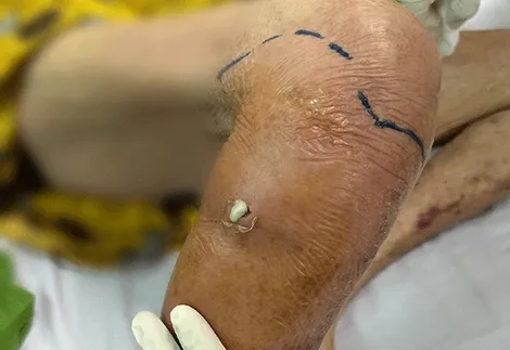 Cứu kịp cụ bà bị nhiễm trùng huyết nguy kịch từ vết xước nhỏ