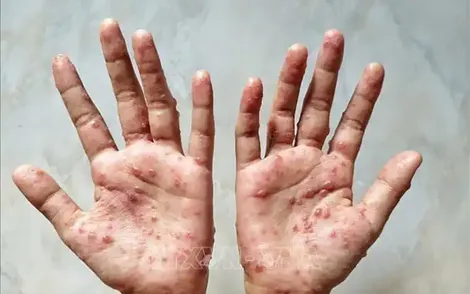 Vaccine đậu mùa khỉ chỉ cần thiết đối với các nhóm nguy cơ cao