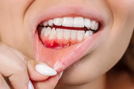 Bệnh răng miệng có thể làm tăng nguy cơ đột quỵ