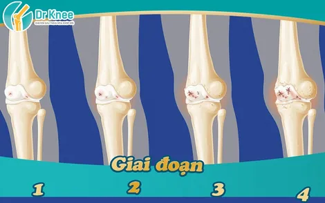 Phác Đồ Điều Trị Thoái Hóa Khớp Gối